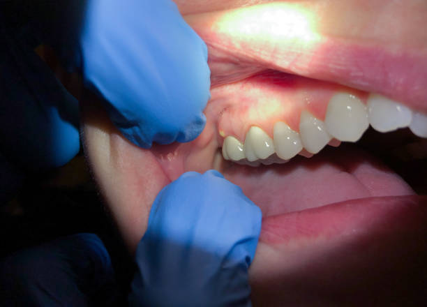 Best Emergency Dentist for Lost Fillings or Crowns in East Glenville, NY